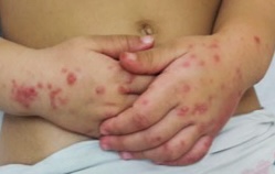 Le syndrome de Coxsackie ou Maladie «Pieds-Mains-Bouche » 1
